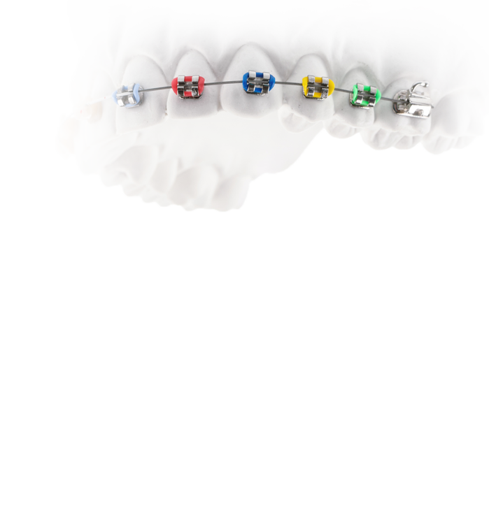 Zahnspange außenliegende Brackets